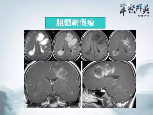 【病例】Clippers综合征1例MR影像表现