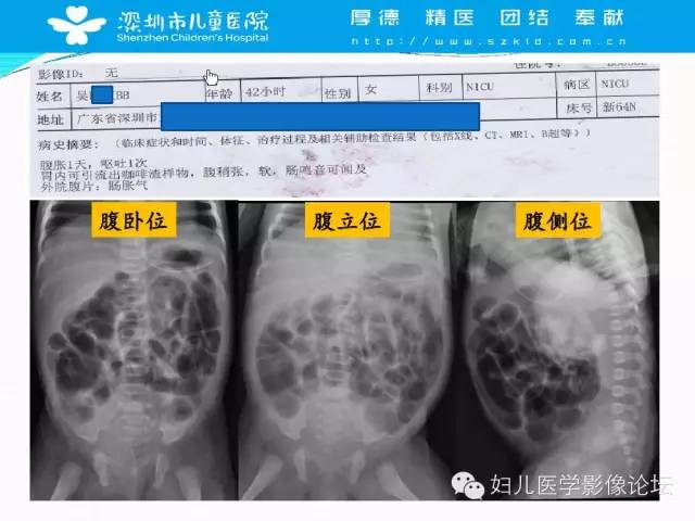 【PPT】先天性巨结肠的影像诊断