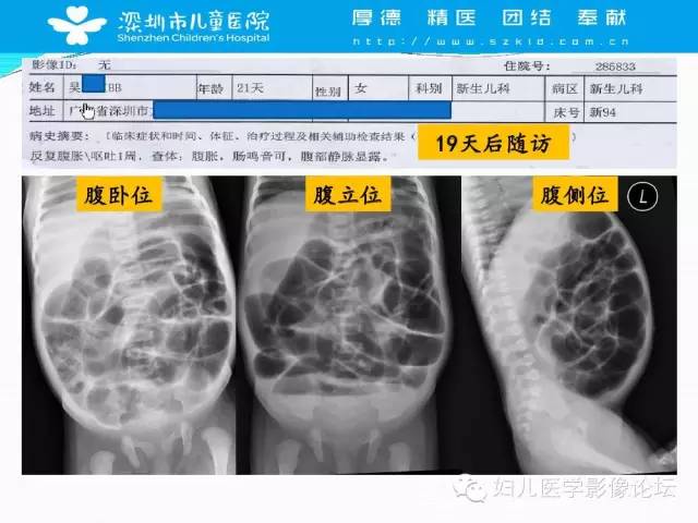 【PPT】先天性巨结肠的影像诊断