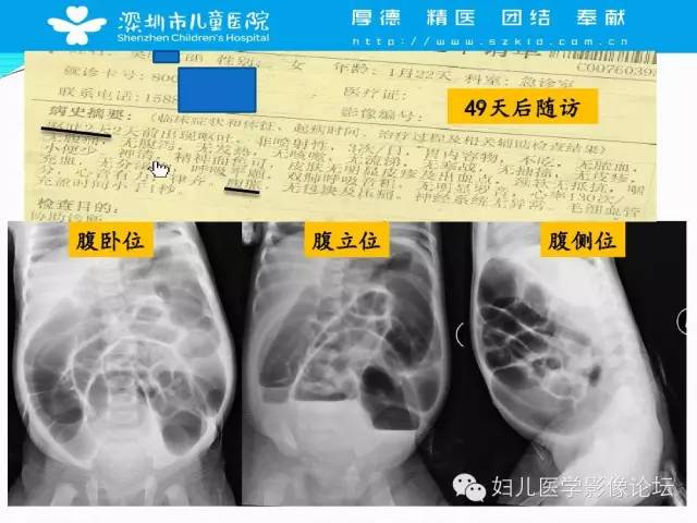 【PPT】先天性巨结肠的影像诊断