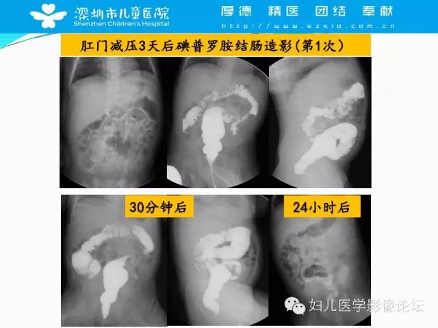【PPT】先天性巨结肠的影像诊断