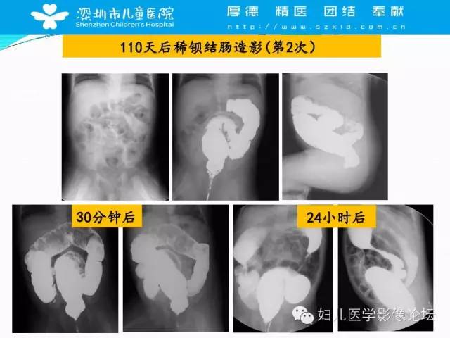 【PPT】先天性巨结肠的影像诊断