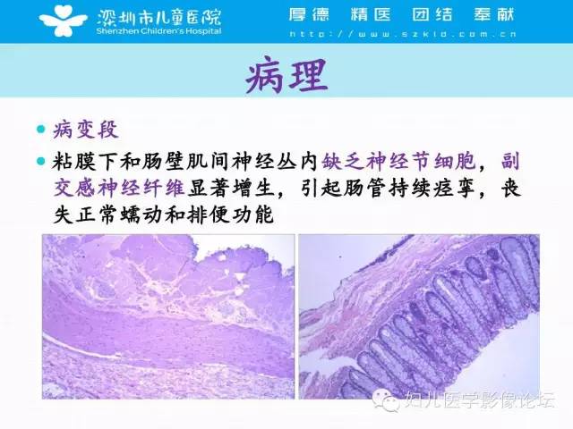 【PPT】先天性巨结肠的影像诊断