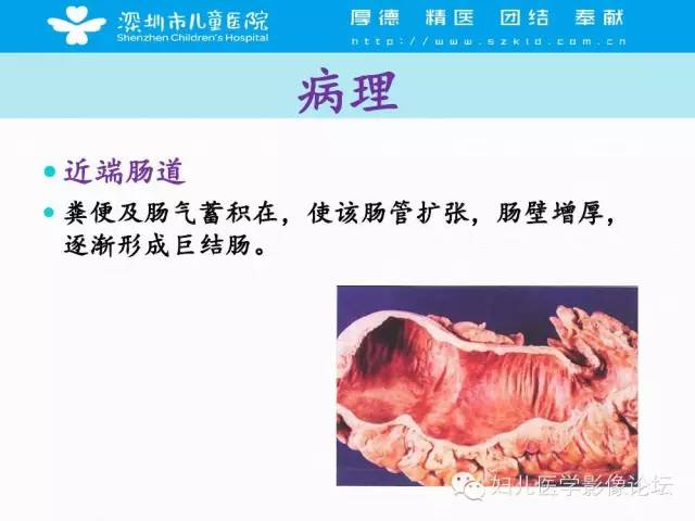 【PPT】先天性巨结肠的影像诊断