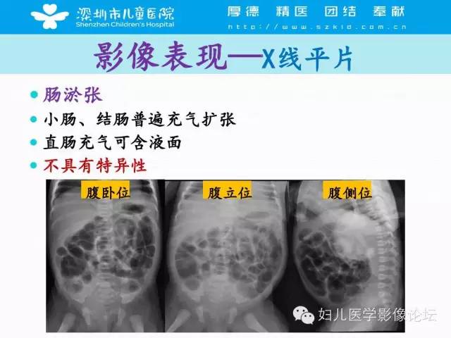 【PPT】先天性巨结肠的影像诊断