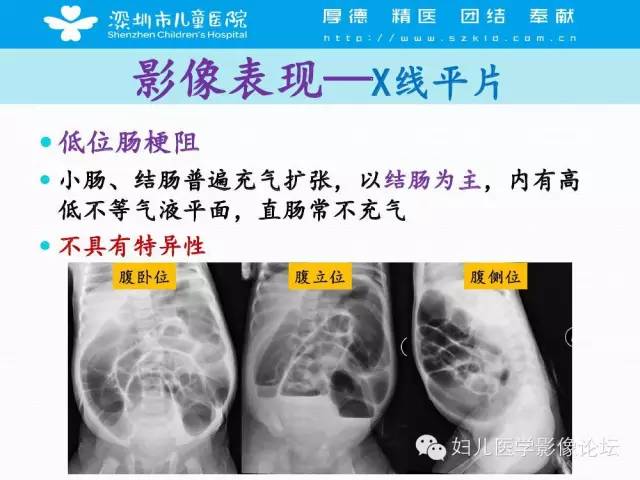 【PPT】先天性巨结肠的影像诊断