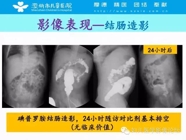 【PPT】先天性巨结肠的影像诊断