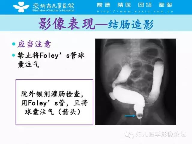 【PPT】先天性巨结肠的影像诊断