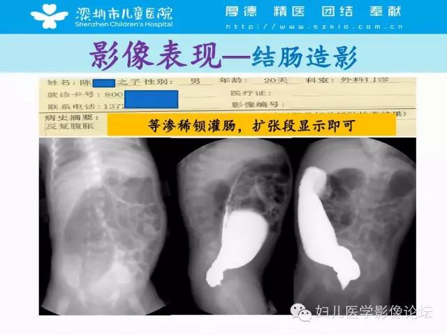 【PPT】先天性巨结肠的影像诊断