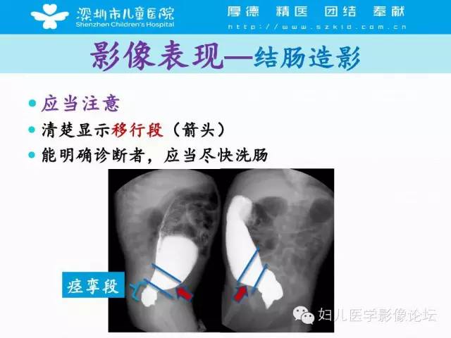 【PPT】先天性巨结肠的影像诊断