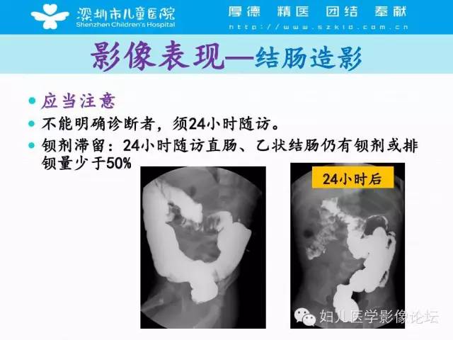 【PPT】先天性巨结肠的影像诊断