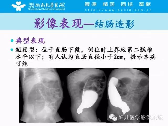 【PPT】先天性巨结肠的影像诊断
