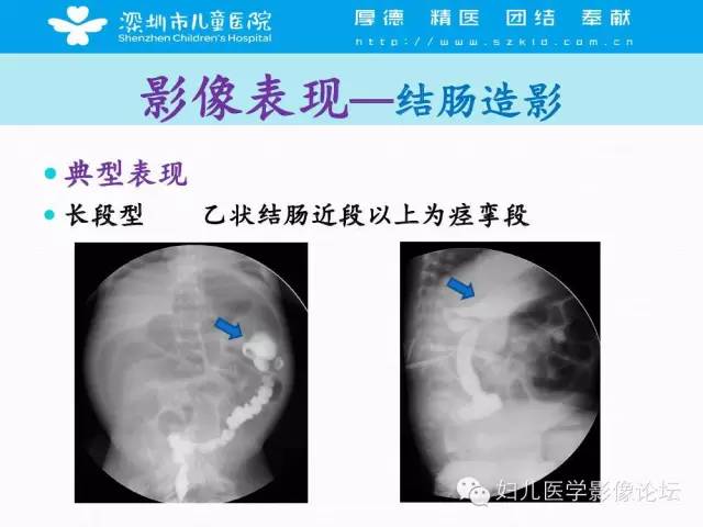 【PPT】先天性巨结肠的影像诊断