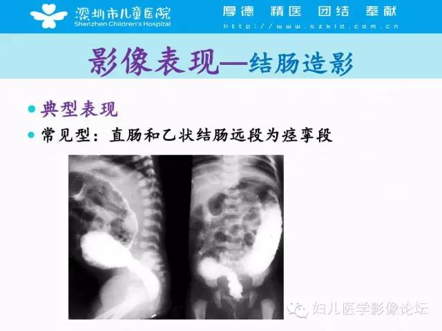 【PPT】先天性巨结肠的影像诊断