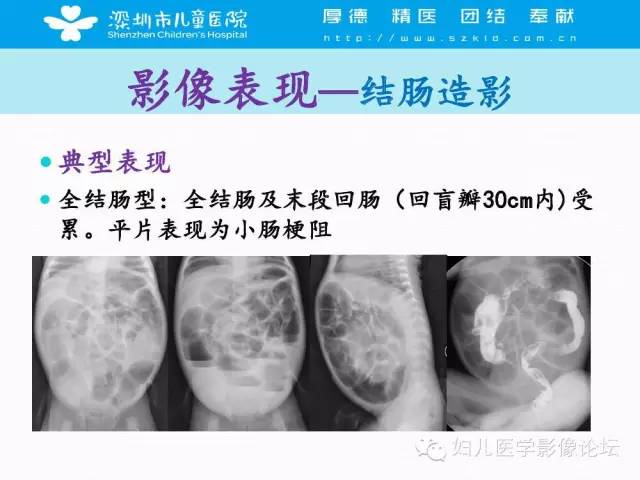 【PPT】先天性巨结肠的影像诊断