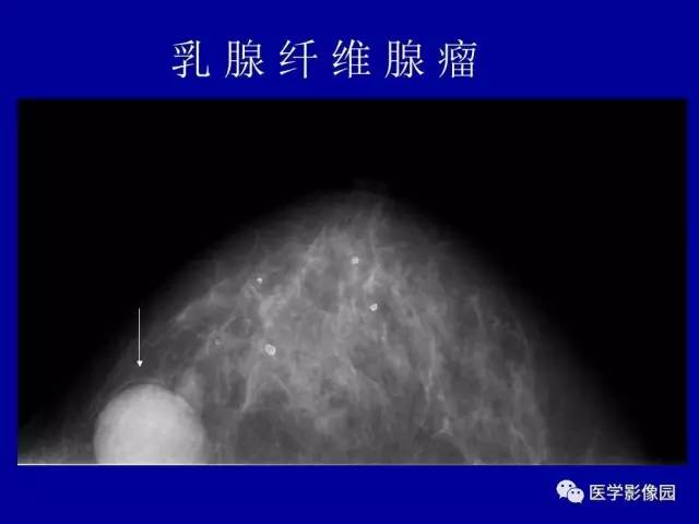【PPT】乳腺肿瘤影像检查方法与诊断思路