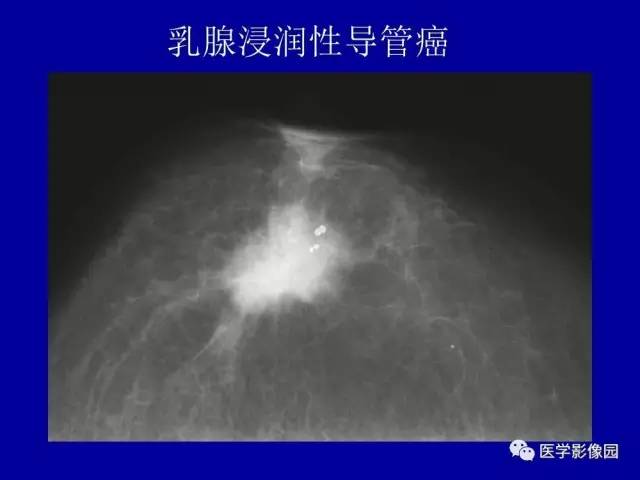 【PPT】乳腺肿瘤影像检查方法与诊断思路