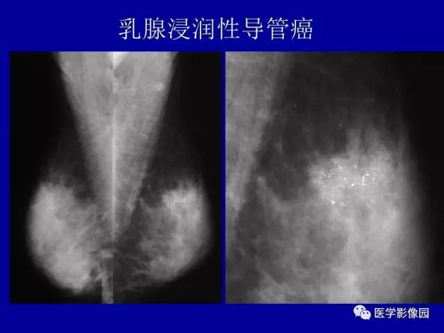 【PPT】乳腺肿瘤影像检查方法与诊断思路