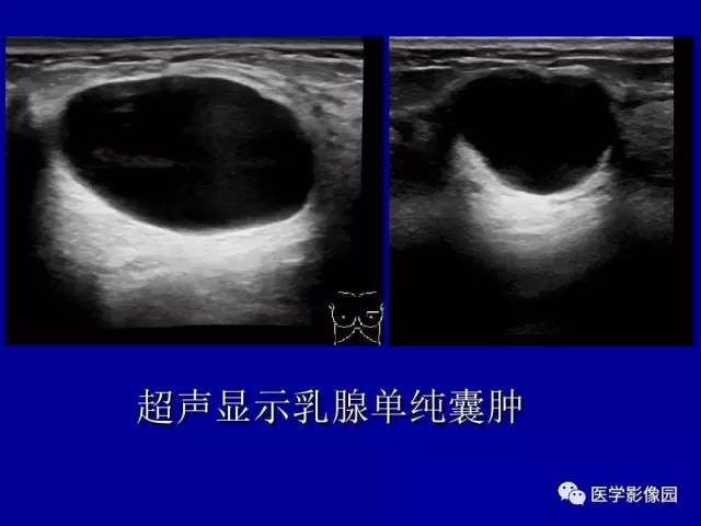 【PPT】乳腺肿瘤影像检查方法与诊断思路