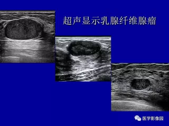 【PPT】乳腺肿瘤影像检查方法与诊断思路