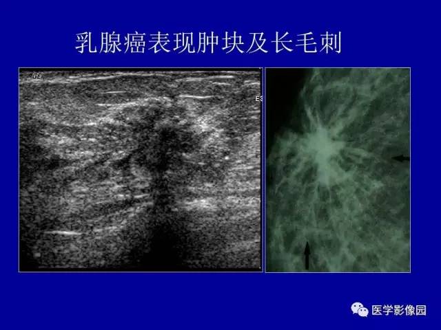 【PPT】乳腺肿瘤影像检查方法与诊断思路