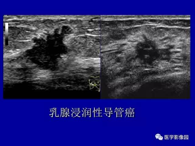 【PPT】乳腺肿瘤影像检查方法与诊断思路