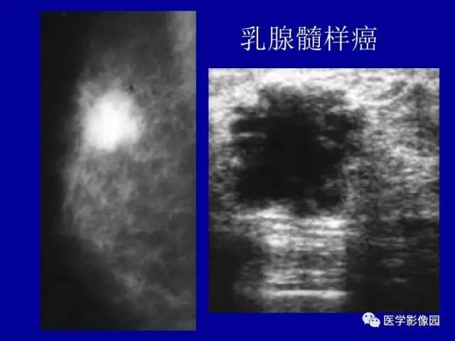 【PPT】乳腺肿瘤影像检查方法与诊断思路