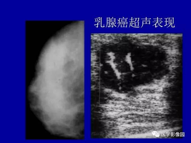 【PPT】乳腺肿瘤影像检查方法与诊断思路