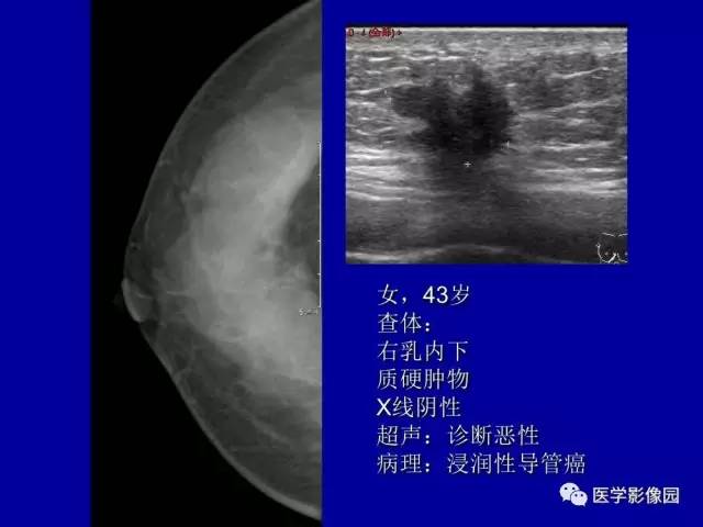 【PPT】乳腺肿瘤影像检查方法与诊断思路