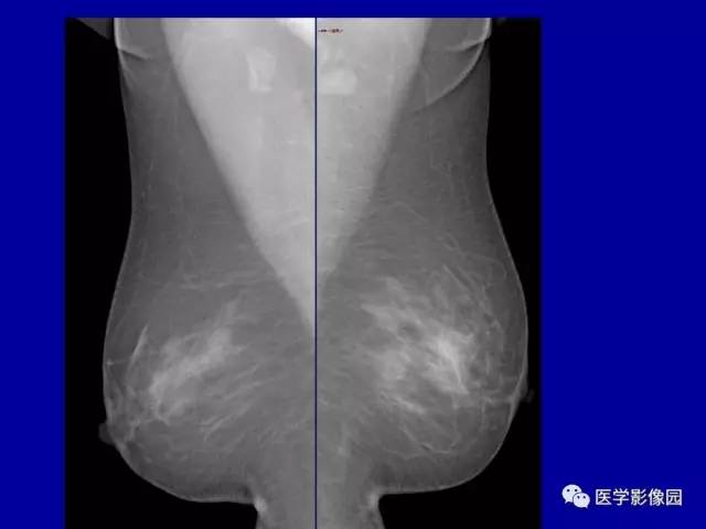 【PPT】乳腺肿瘤影像检查方法与诊断思路