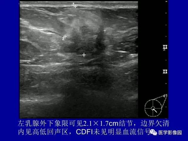 【PPT】乳腺肿瘤影像检查方法与诊断思路