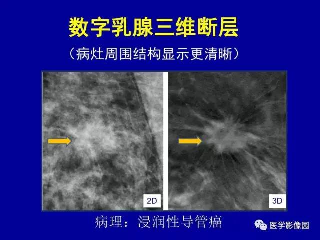 【PPT】乳腺肿瘤影像检查方法与诊断思路