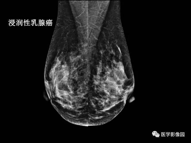 【PPT】乳腺肿瘤影像检查方法与诊断思路