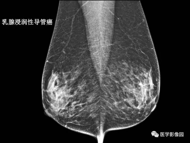 【PPT】乳腺肿瘤影像检查方法与诊断思路