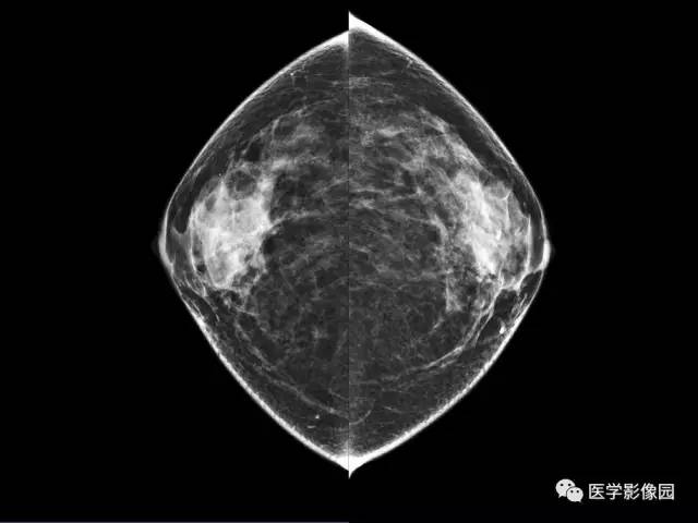 【PPT】乳腺肿瘤影像检查方法与诊断思路