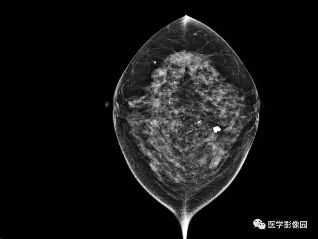 【PPT】乳腺肿瘤影像检查方法与诊断思路