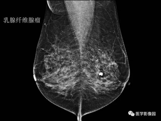【PPT】乳腺肿瘤影像检查方法与诊断思路