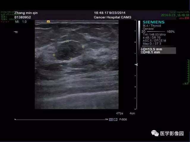 【PPT】乳腺肿瘤影像检查方法与诊断思路