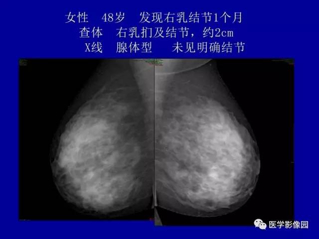 【PPT】乳腺肿瘤影像检查方法与诊断思路