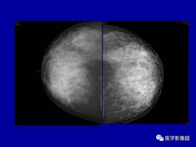【PPT】乳腺肿瘤影像检查方法与诊断思路
