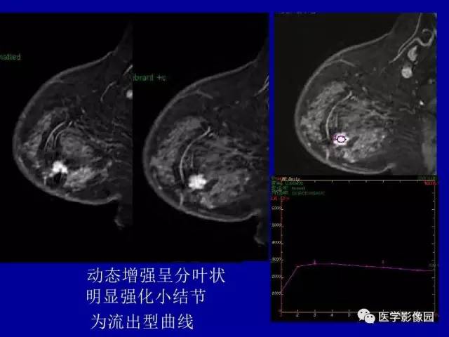 【PPT】乳腺肿瘤影像检查方法与诊断思路