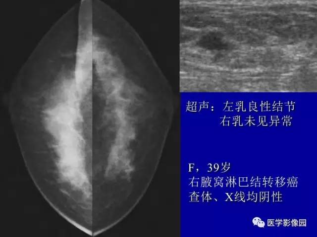【PPT】乳腺肿瘤影像检查方法与诊断思路