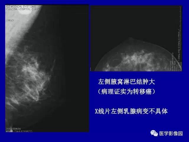 【PPT】乳腺肿瘤影像检查方法与诊断思路