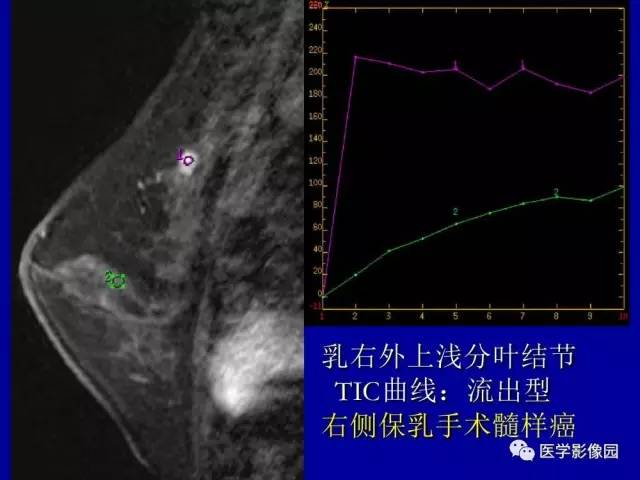 【PPT】乳腺肿瘤影像检查方法与诊断思路