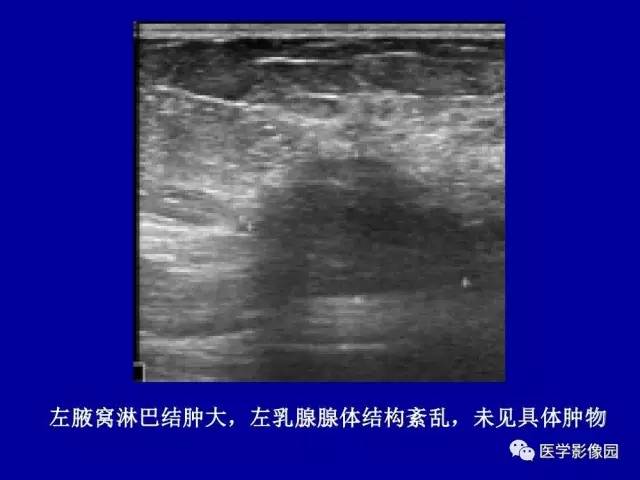 【PPT】乳腺肿瘤影像检查方法与诊断思路