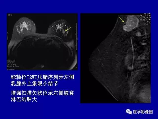 【PPT】乳腺肿瘤影像检查方法与诊断思路
