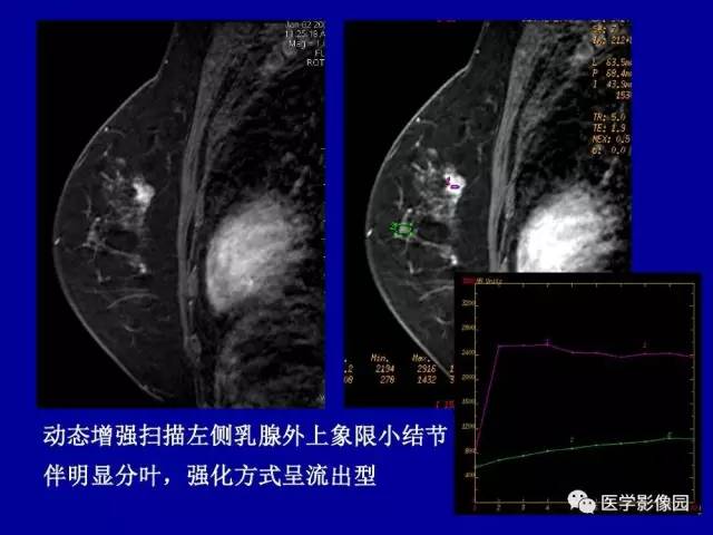 【PPT】乳腺肿瘤影像检查方法与诊断思路