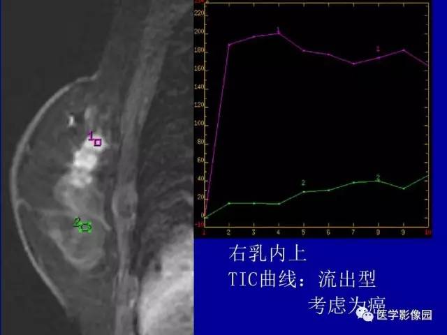 【PPT】乳腺肿瘤影像检查方法与诊断思路
