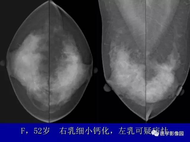 【PPT】乳腺肿瘤影像检查方法与诊断思路