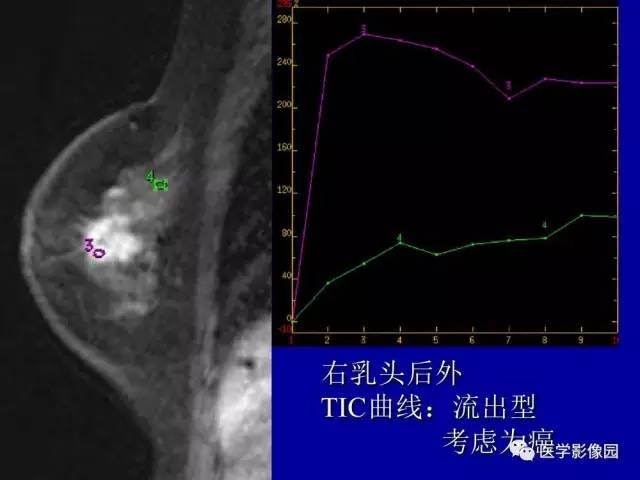 【PPT】乳腺肿瘤影像检查方法与诊断思路